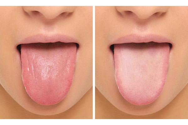 علائم کم خونی در رنگ زبان