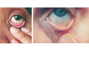 علائم کم خونی در پلک چشم